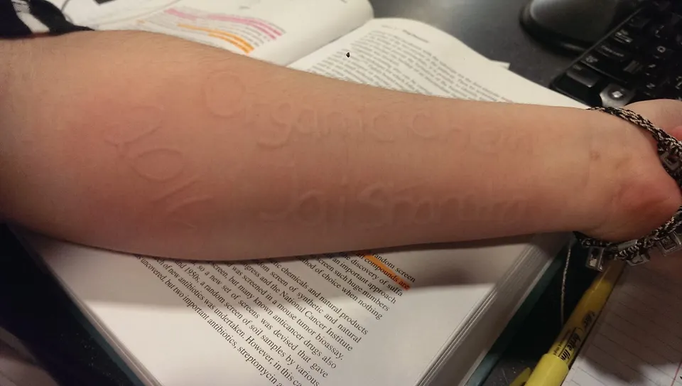 Contextual file photo: dermatographism on a forearm, the skin condition for which Rhapsido was approved